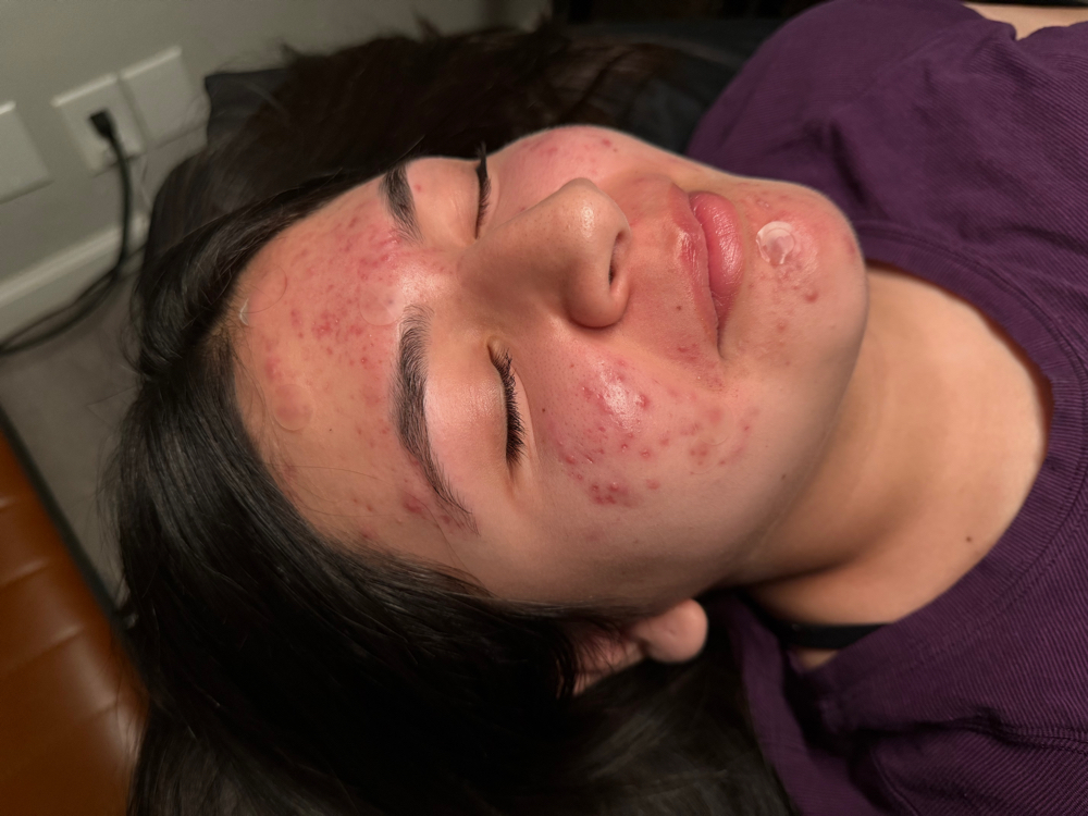 First-Time Acne Facial