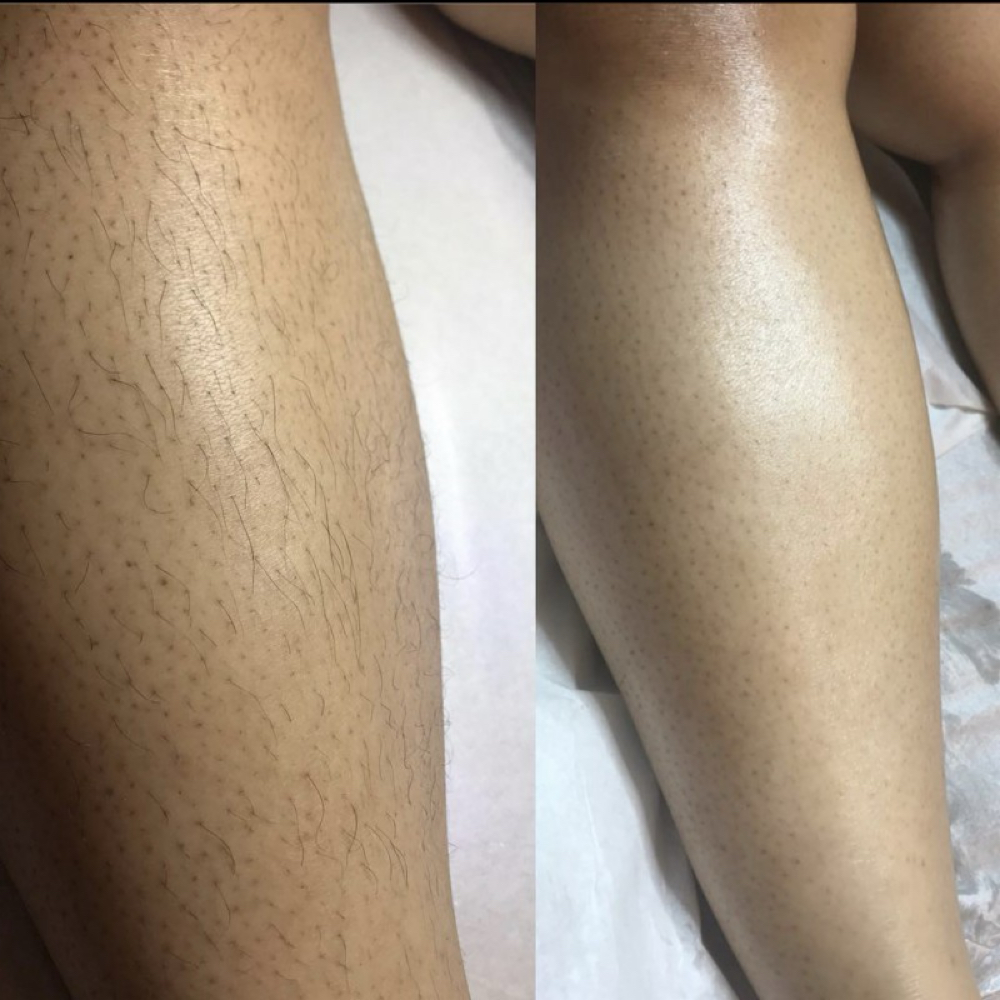 Half Legs at WaxLand & BodySculpting in Los Angeles, CA