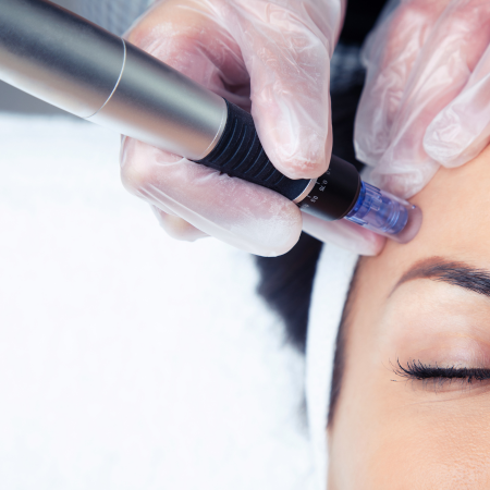 Microneedling Facial