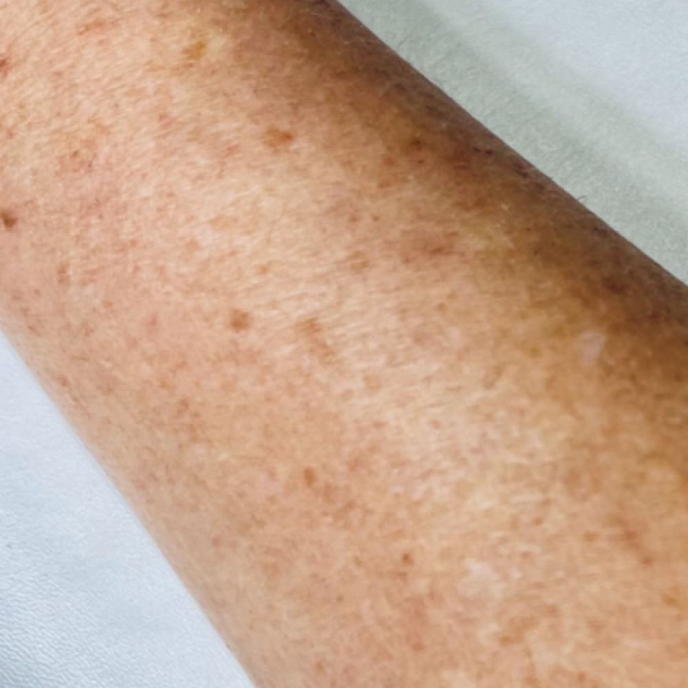 Sun Spot Removal at Erika’s Beauty Lab in Littleton, CO