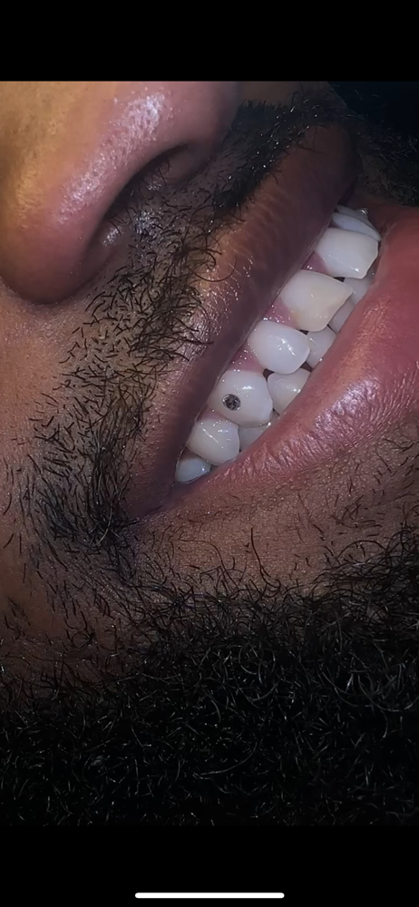 1 Crystal 🦷💎
