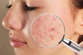 Acne Clear Facial