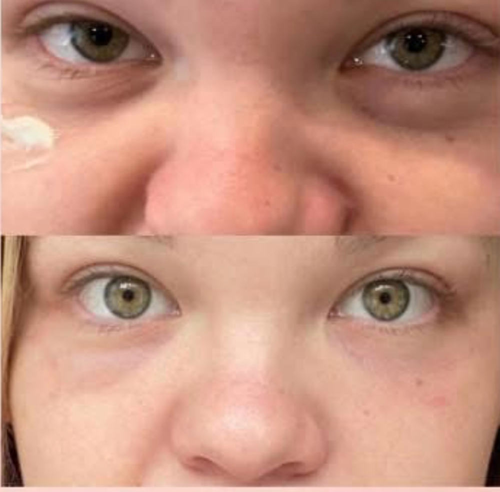 Under eye PRP ONLY at Candice Stacy in Gilbert, WV