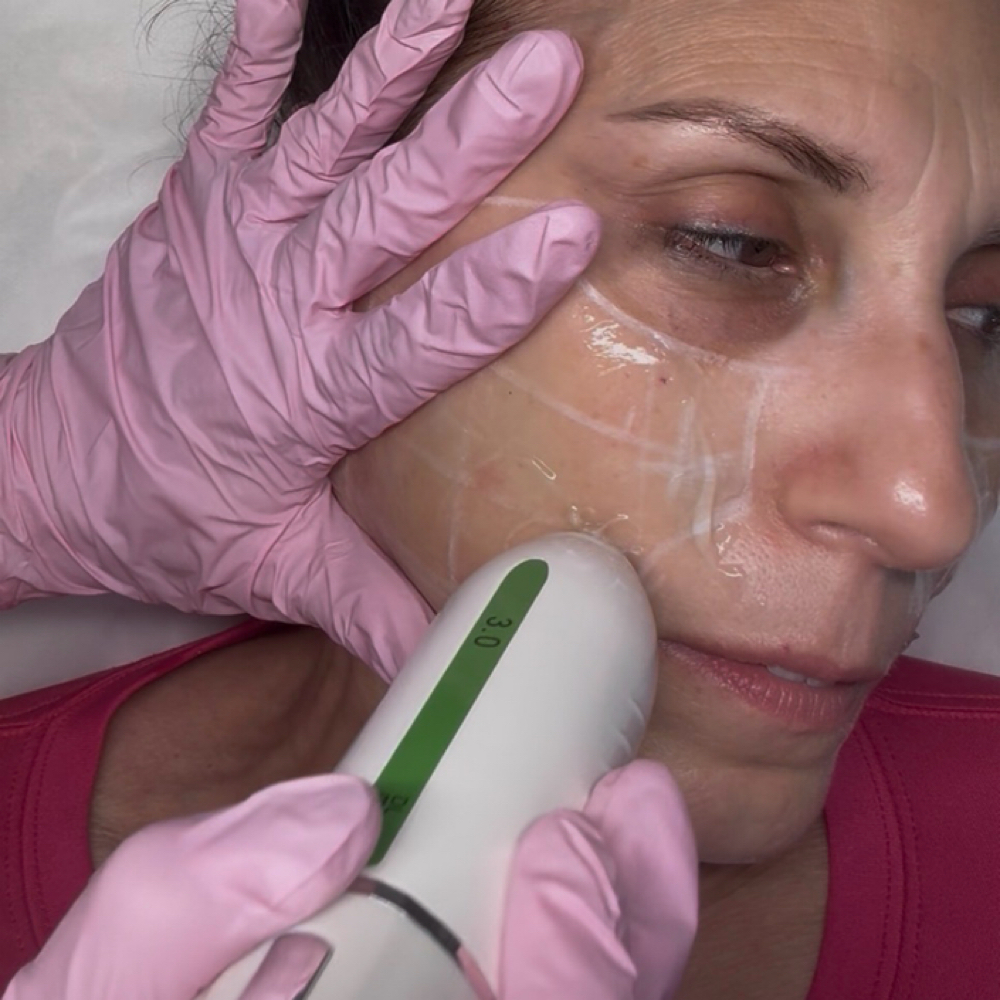 Ultrasound Collagen Stimulation