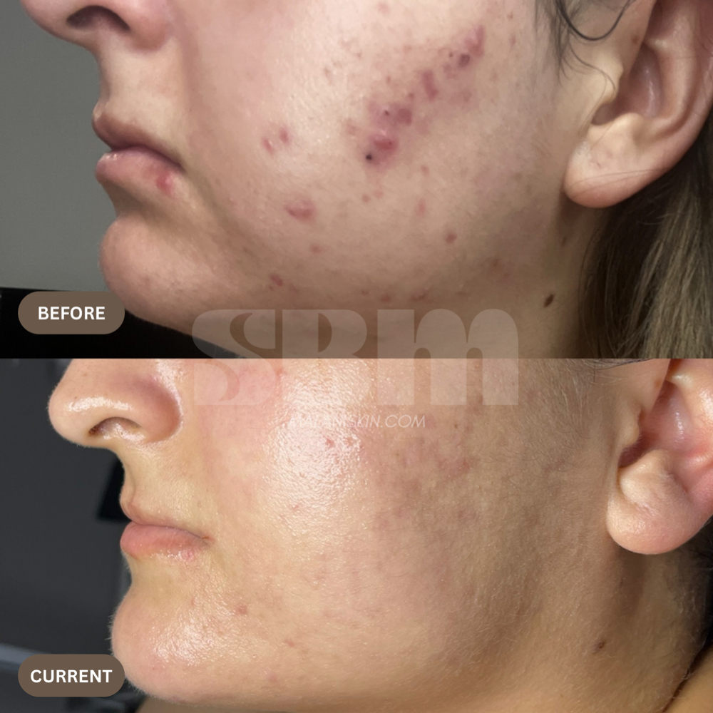 THE ELEVATION at SBM SKIN STUDIO in Whittier, CA