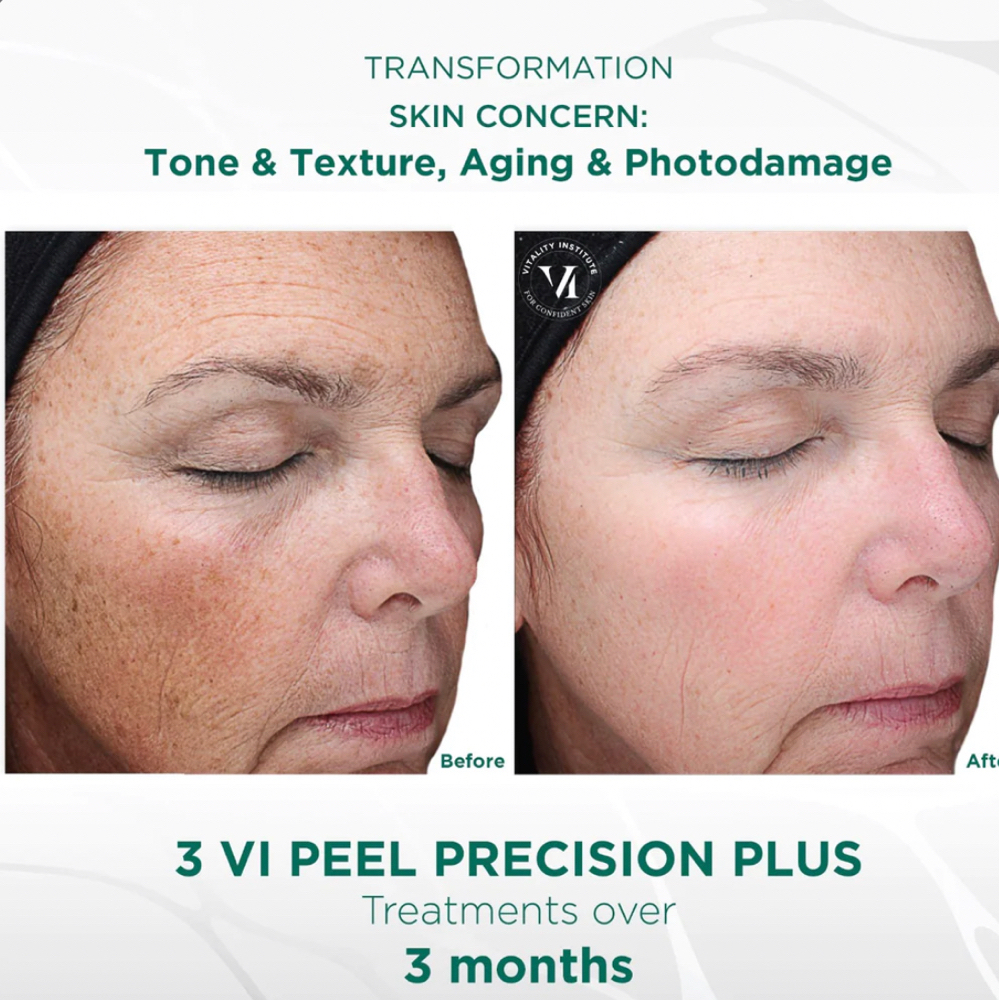 Vi Peel with Precision Plus