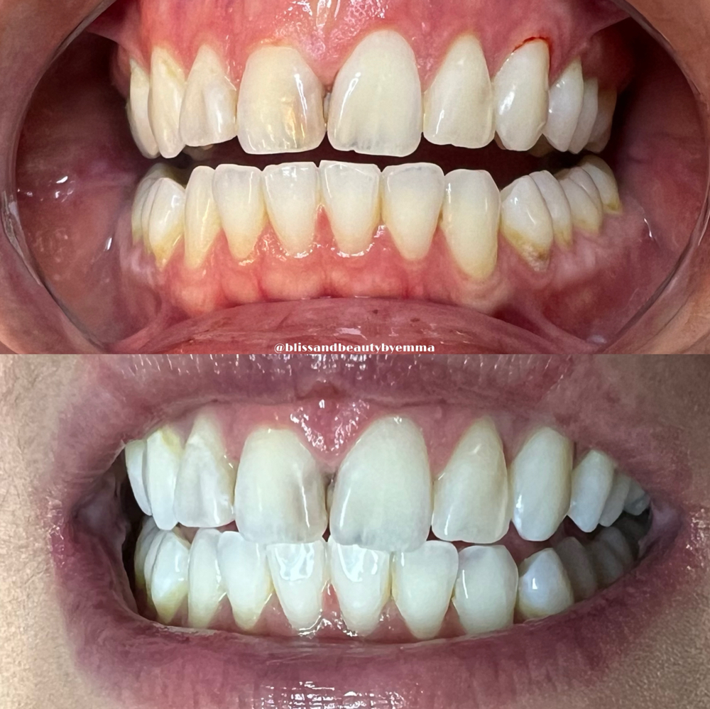 30 Min Express Teeth Whitening