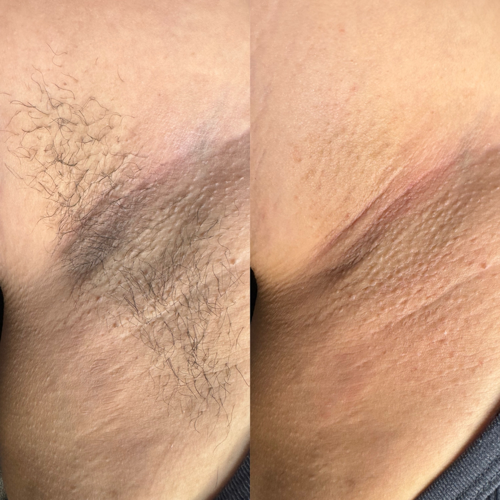 Underarm Waxing