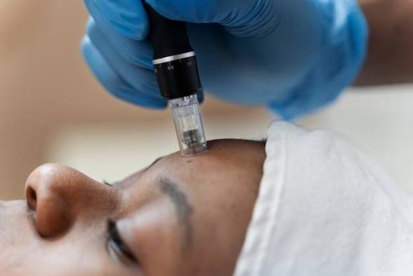 Million Dollar Microneedle Facial