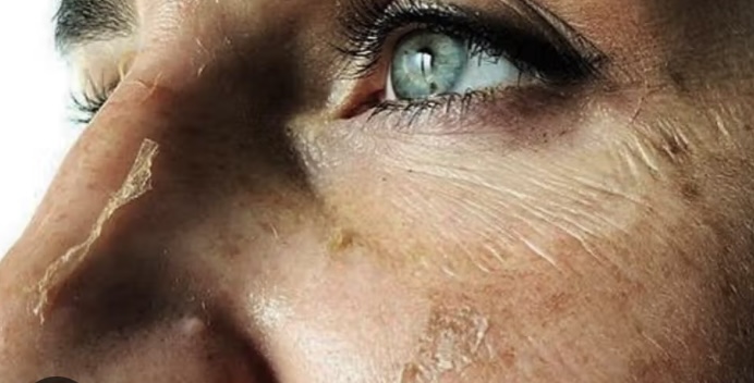 Wrinkle Lift Chemica Peel