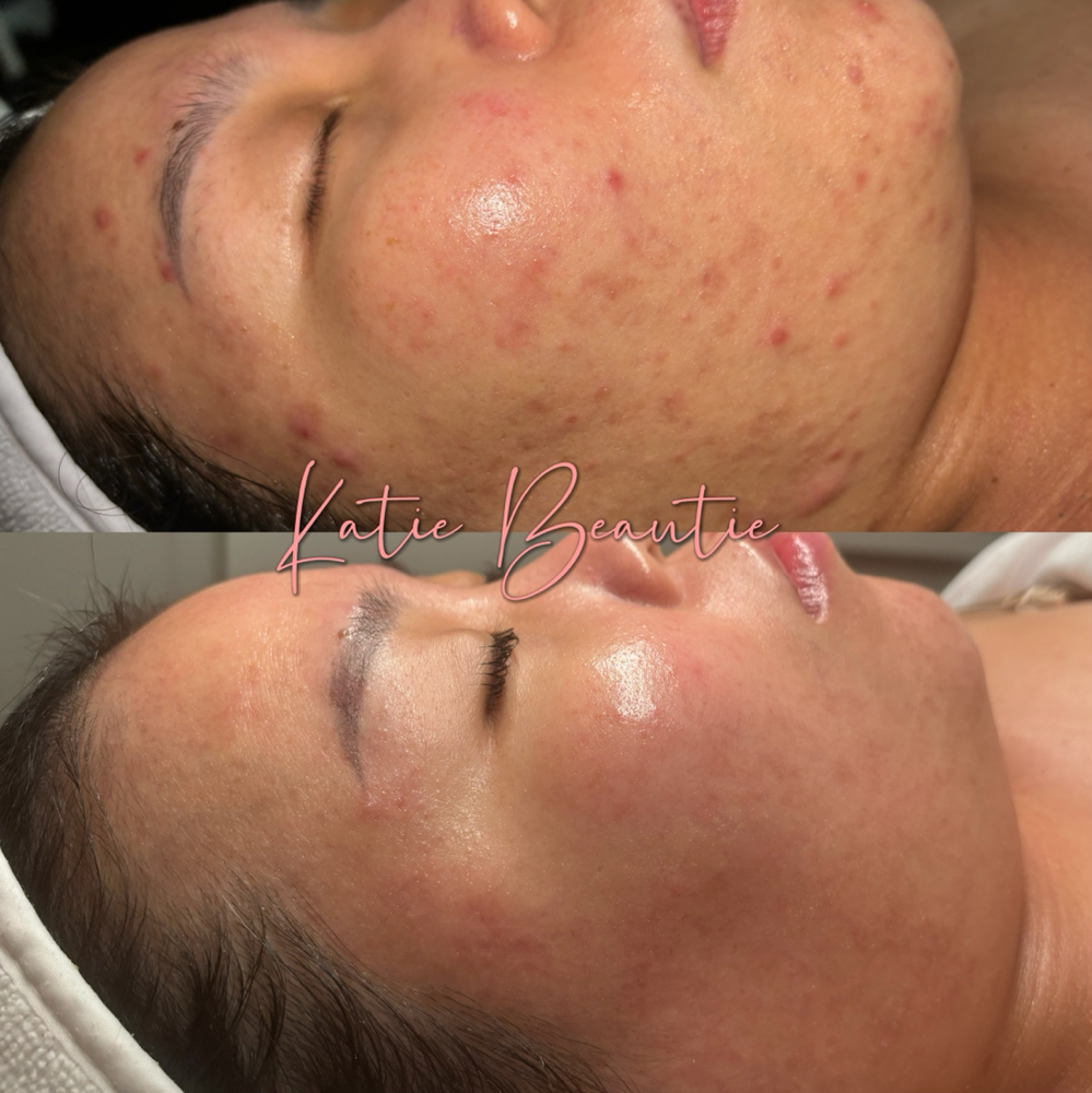 Acne Facial