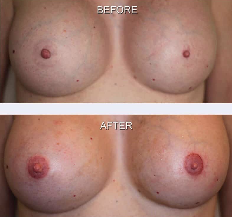 Areola  Color Correction