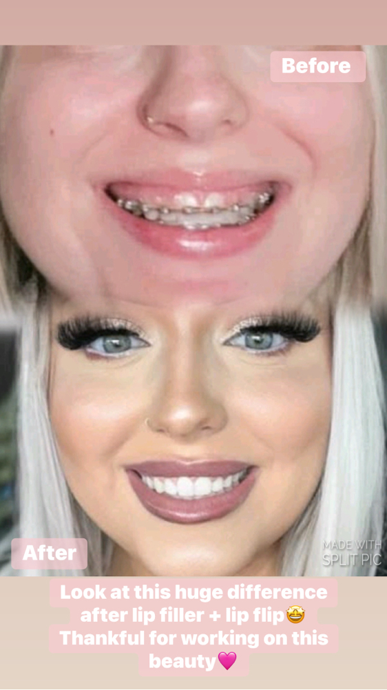 Botox Lip Flip at PuraGlow Aesthetic in Oklahoma City, OK