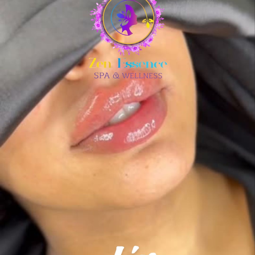 Hyaluronic Acid Dermal Fillers at Zen Essence Spa & Wellness in Brooklyn, NY