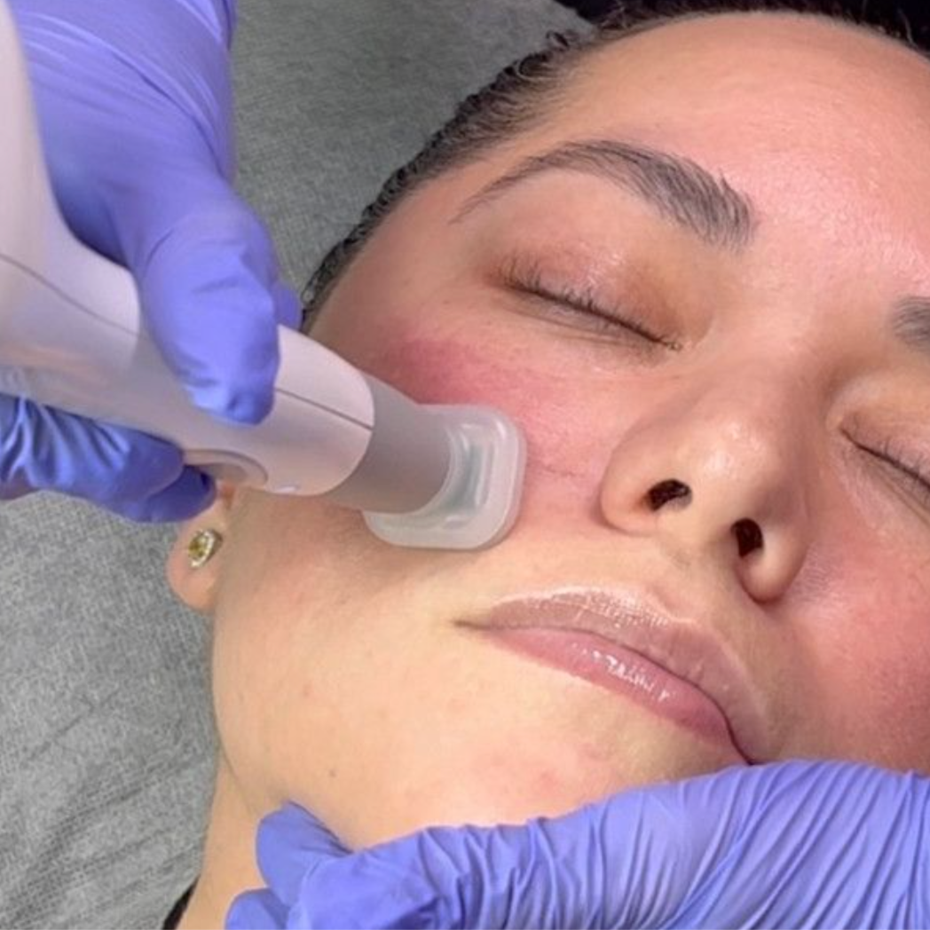 jet plasma add-on at daniskinstudio in Groton, CT