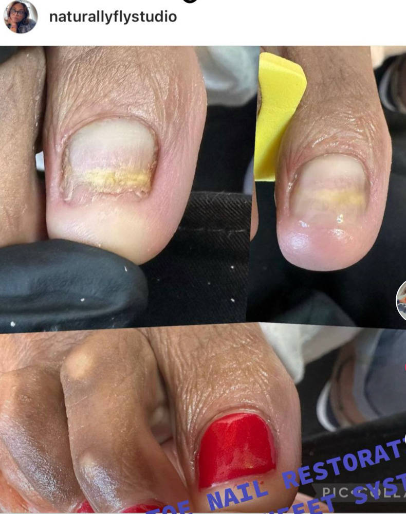 Toe Restoration Treatment: Per Nail