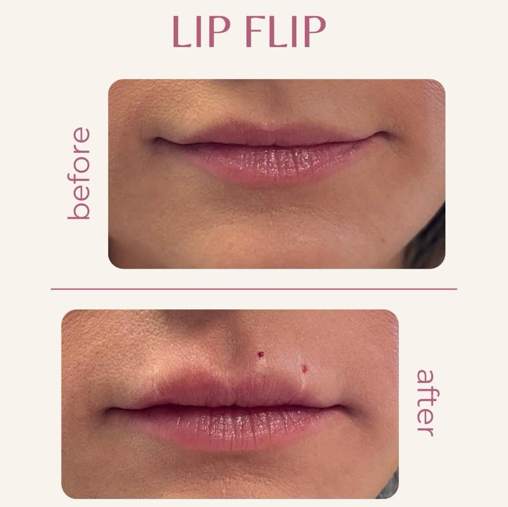 Lip Flip