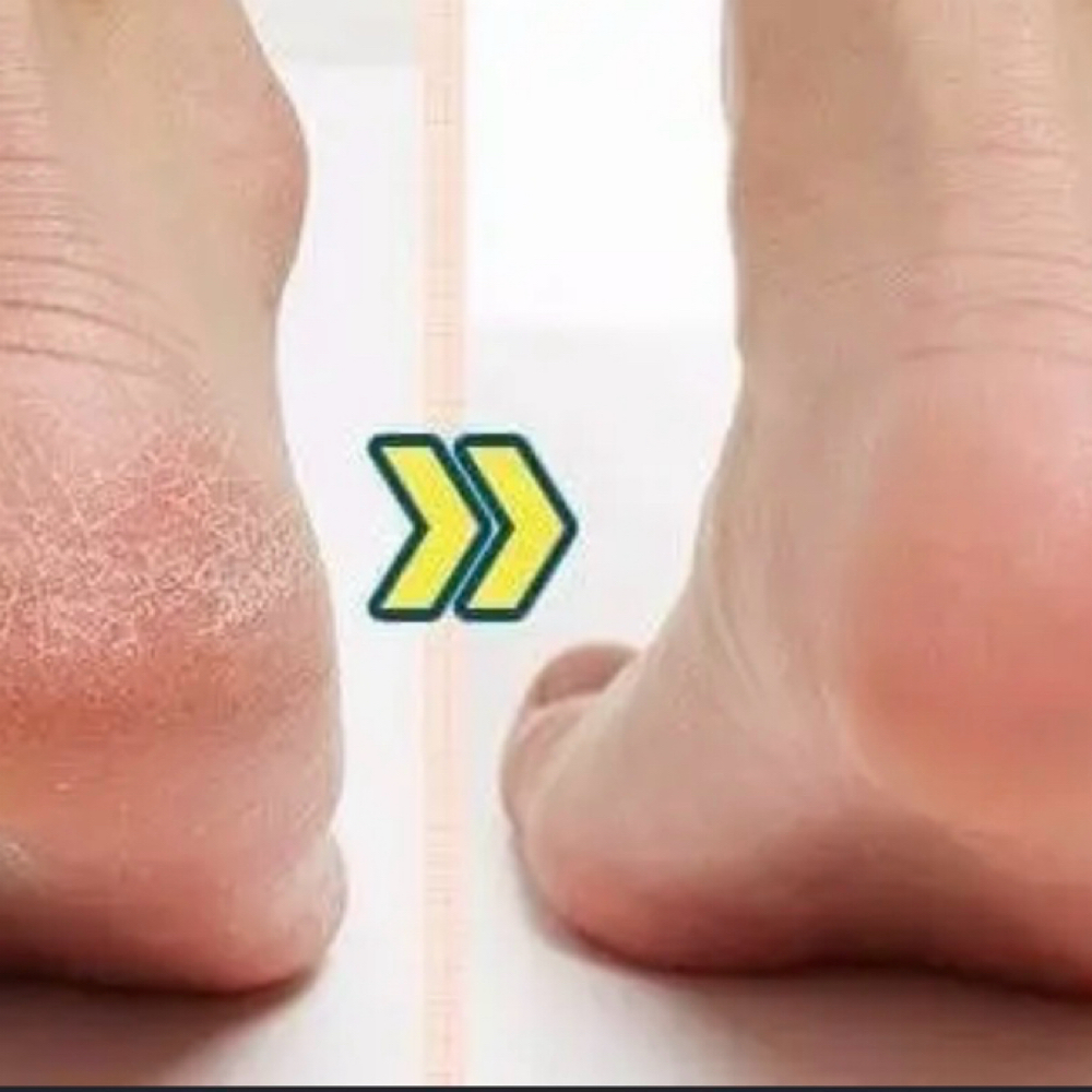 Callus Removal at Sets by Crystalm in Riverside, CA