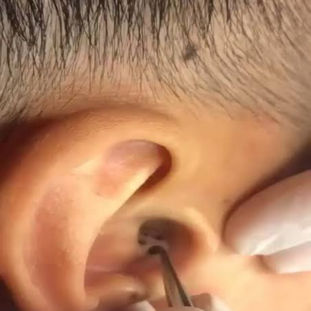 Blackhead Extractions In Ear