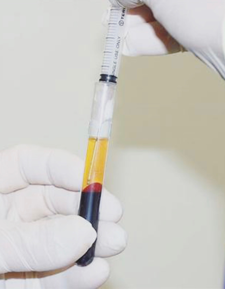 PRP injections