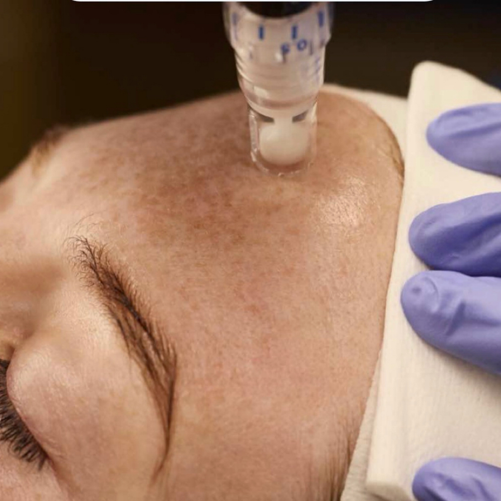 SkinPen Microneedling at BioBeautyAesthetics in Roseville, CA