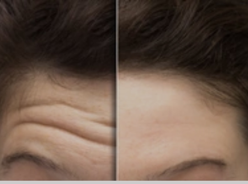 Botox $10/unit