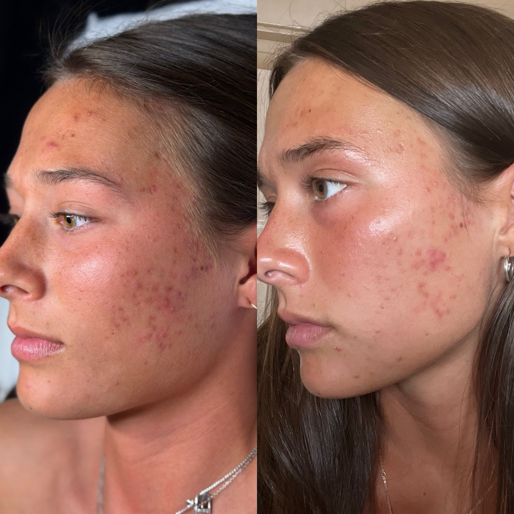 Acne Bootcamp at The Reve Esthetics in Yukon, OK