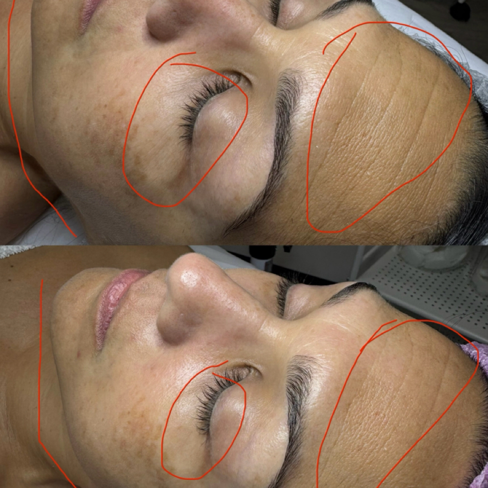 Lymfatic Massage + Anti Age Peel at Healthy skin by Alvina in Highland Park, IL