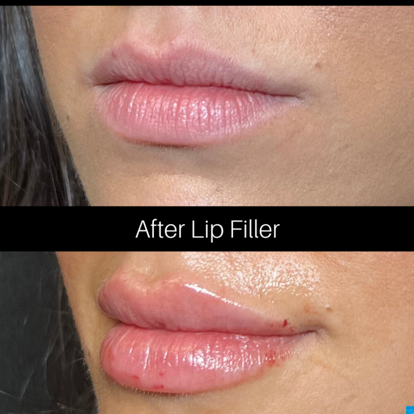Lip Filler at RevIVeU - Bridgeport in Bridgeport, WV