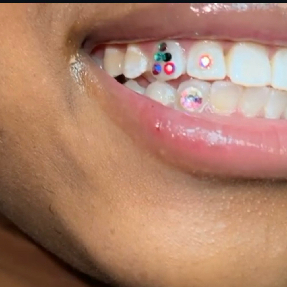 Tooth Gem Freestyle Set at Radiance Skin in Pensacola, FL