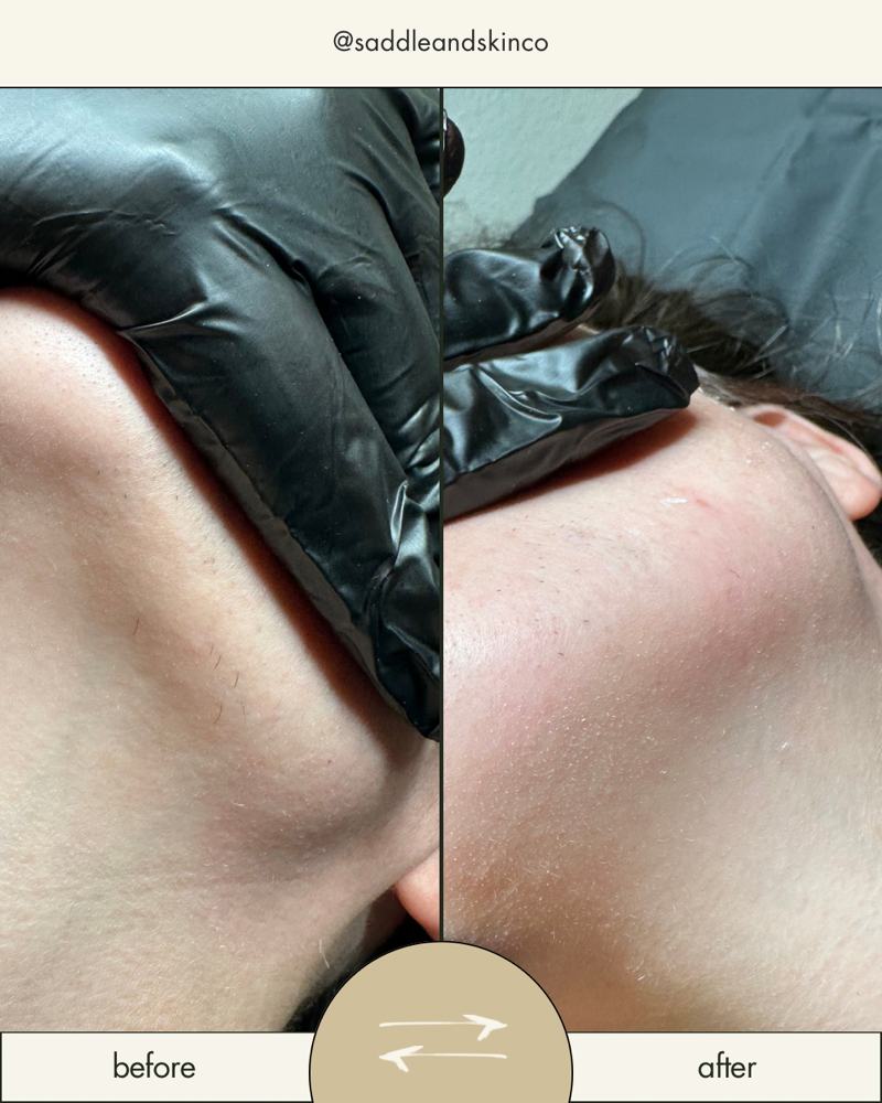 Chin Wax