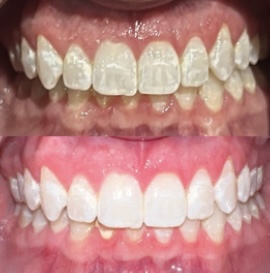 Hollywood glam - Teeth Whitening