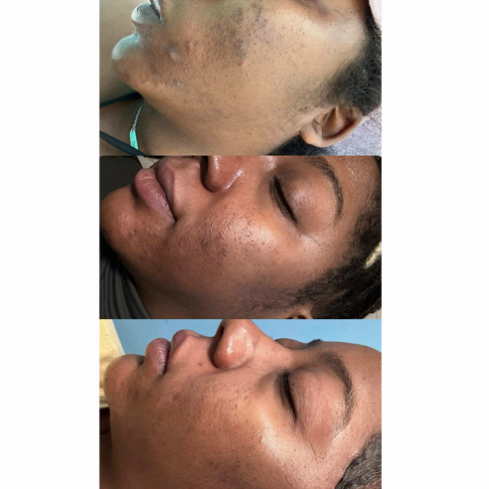 FIRMÉ ADVANCED SIGNATURE TREATMENT at FIRMÉ SKIN in Columbia, MD