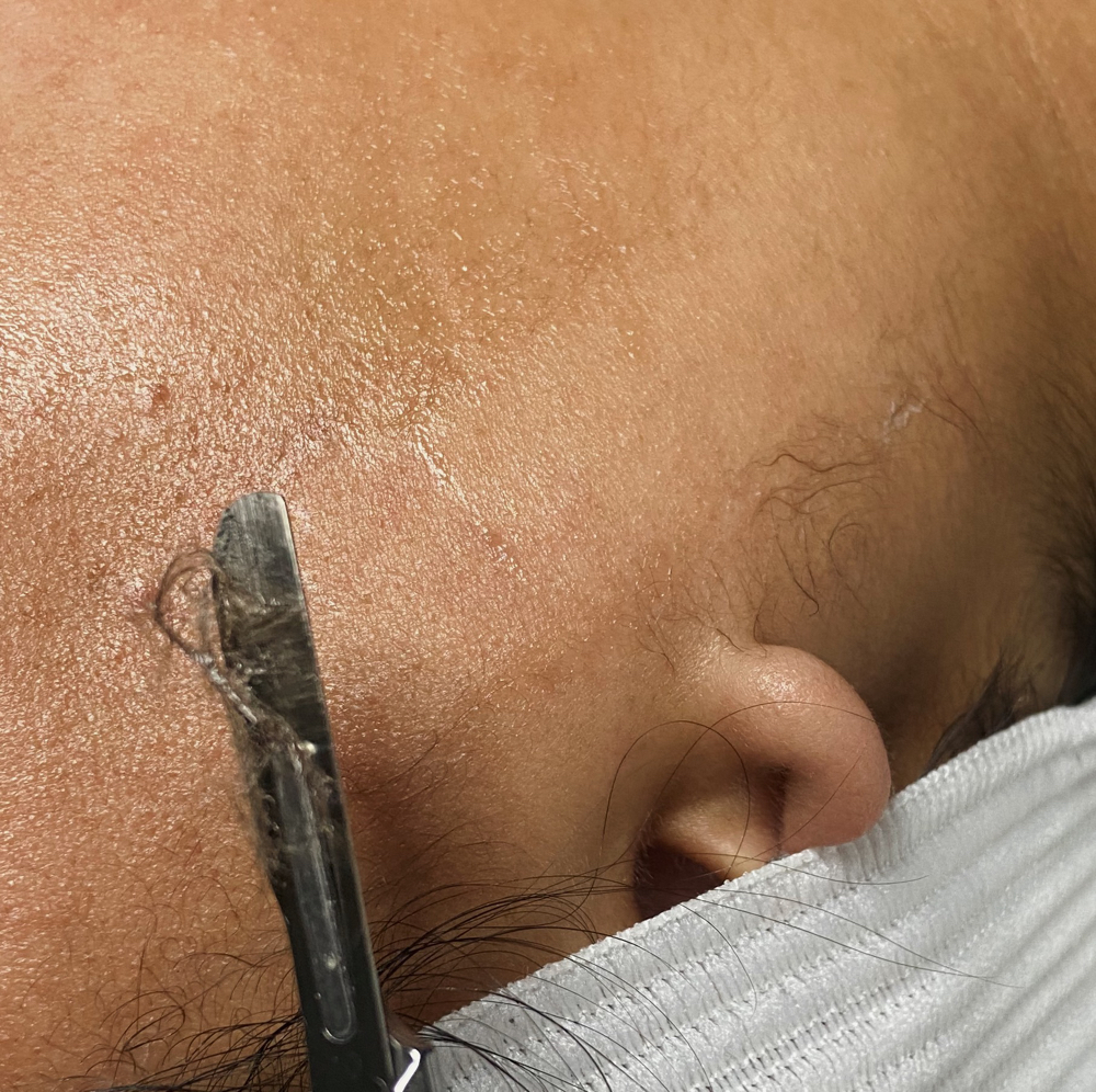 Dermaplane Facial