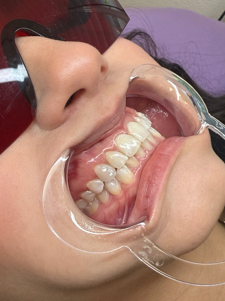 Tooth Gem