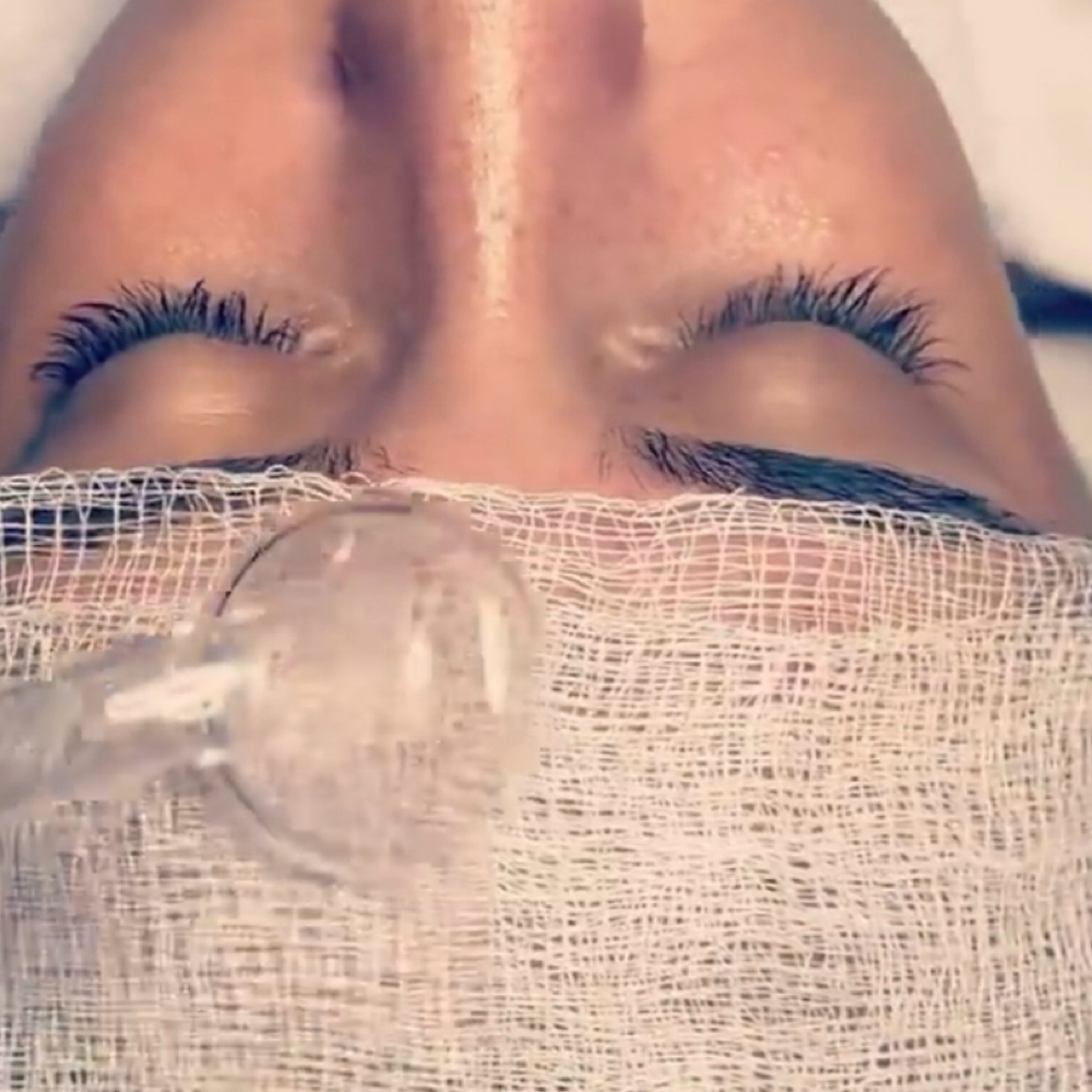 Direct High Frequency Add On