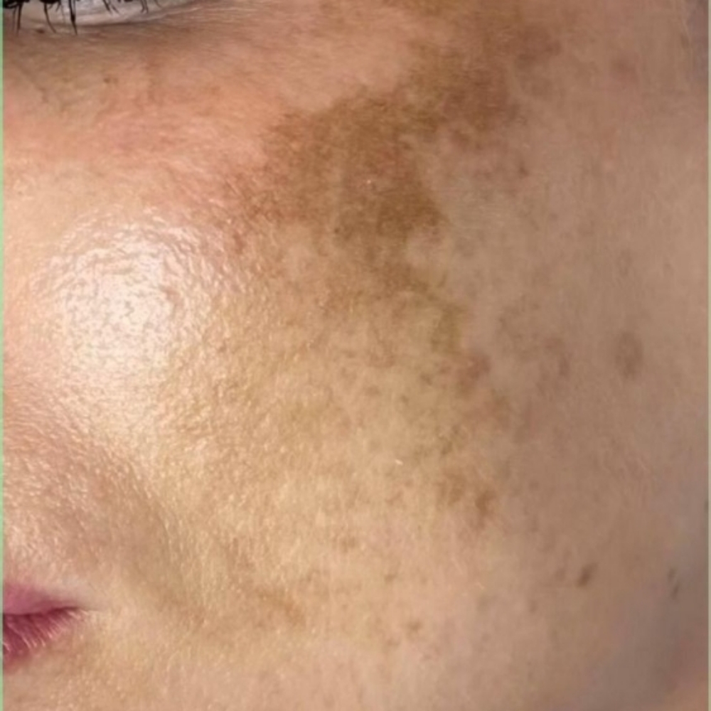 Hyperpigmentation Facial at Crystalyn Couture 👑 Salon & Spa in Surprise, AZ