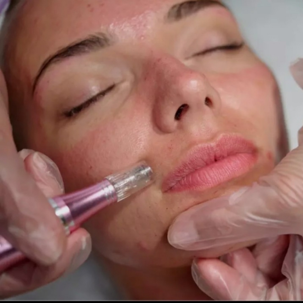 Microneedling/LED at Noemi's Beauty Room LLC in Avondale, AZ