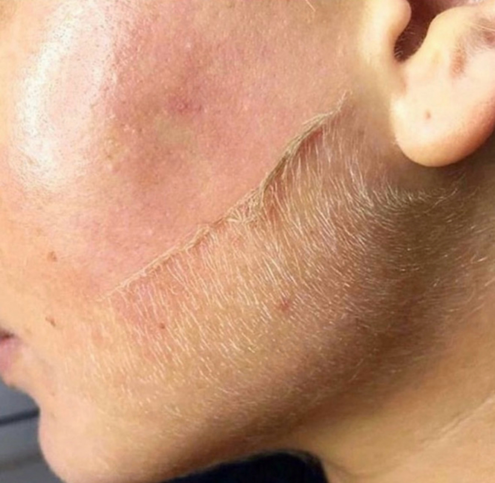 Dermaplaning