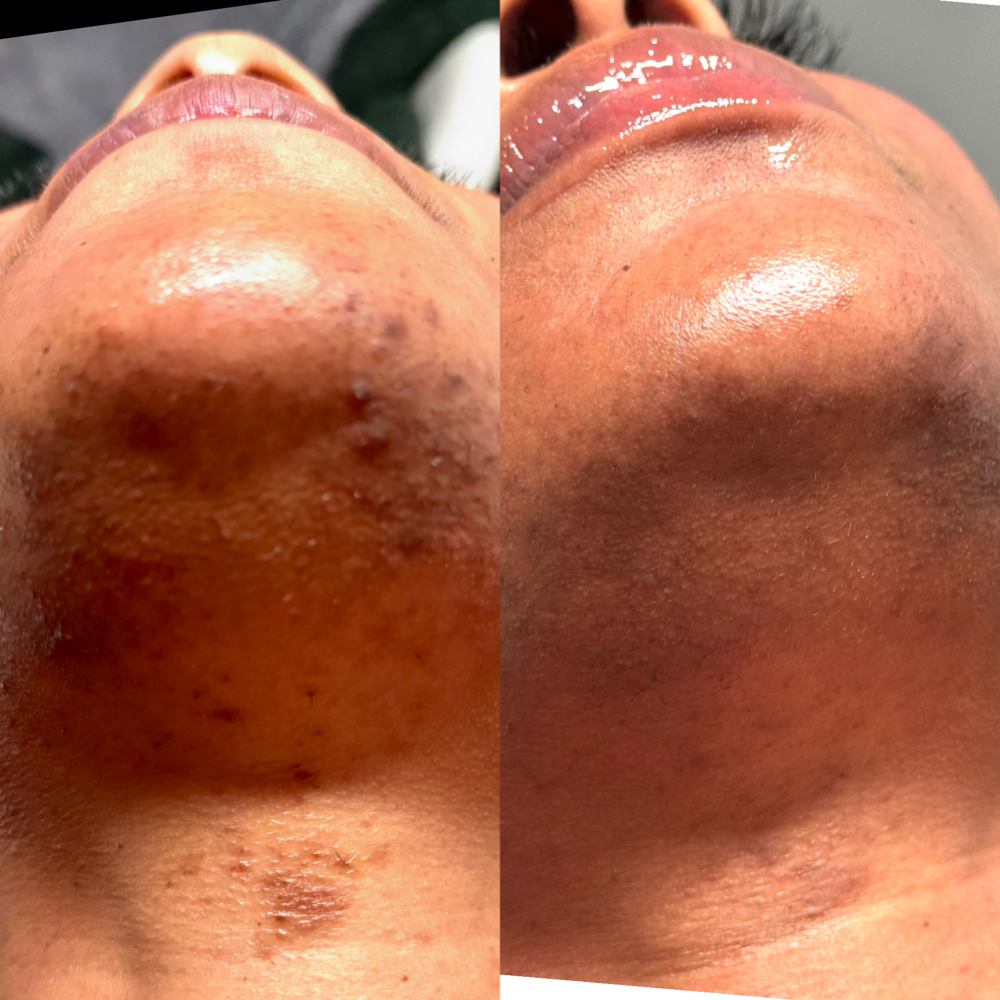 Custom Corrective Peel at Skin Ritual Esthetics in Clayton, NC