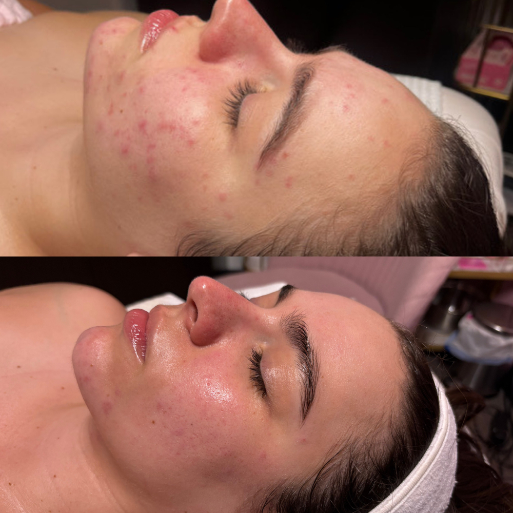 Acne Bootcamp Consult + Treatment at The S Collective in altamonte springs, FL