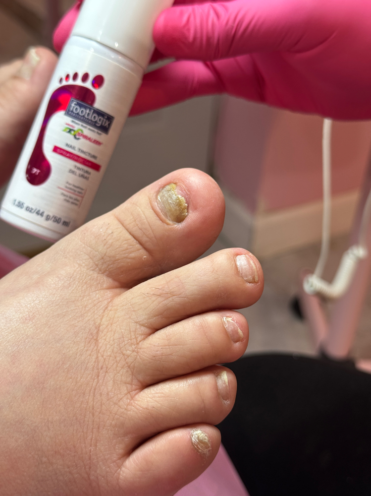 Toe BBL (Infected/ Thick)