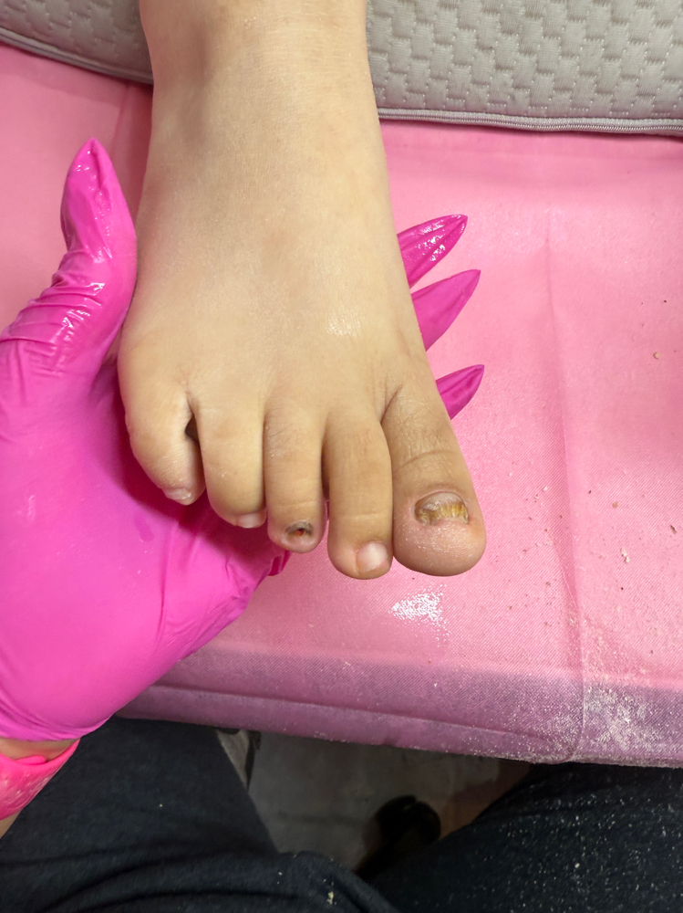 Toe BBL (Infected/ Thick)