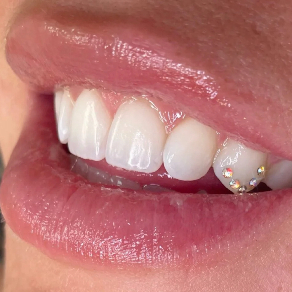 Enhancement — Mini Cluster Upgrade at Luna Smiles in Lexington, SC