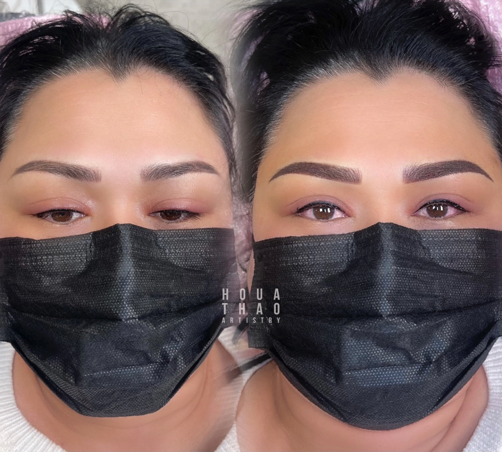 Brow Correction