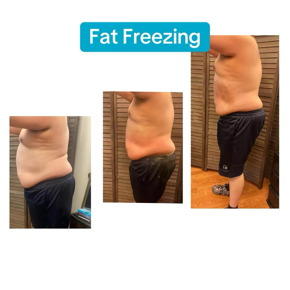 Full Body Fat Freezing at 210 The Body Bar | San Antonio Lux Spray Tans & Body Sculpting in San Antonio, TX