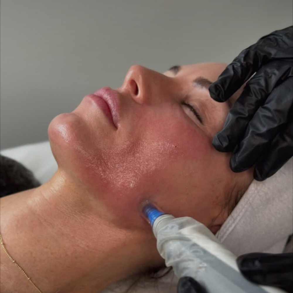 Microneedling single Session at Luxe Skin by Shay in Hewlett, NY