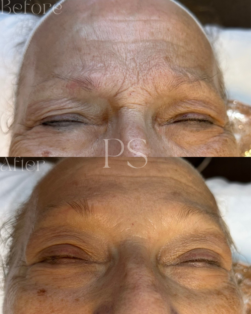 Level II Treatment - Refine