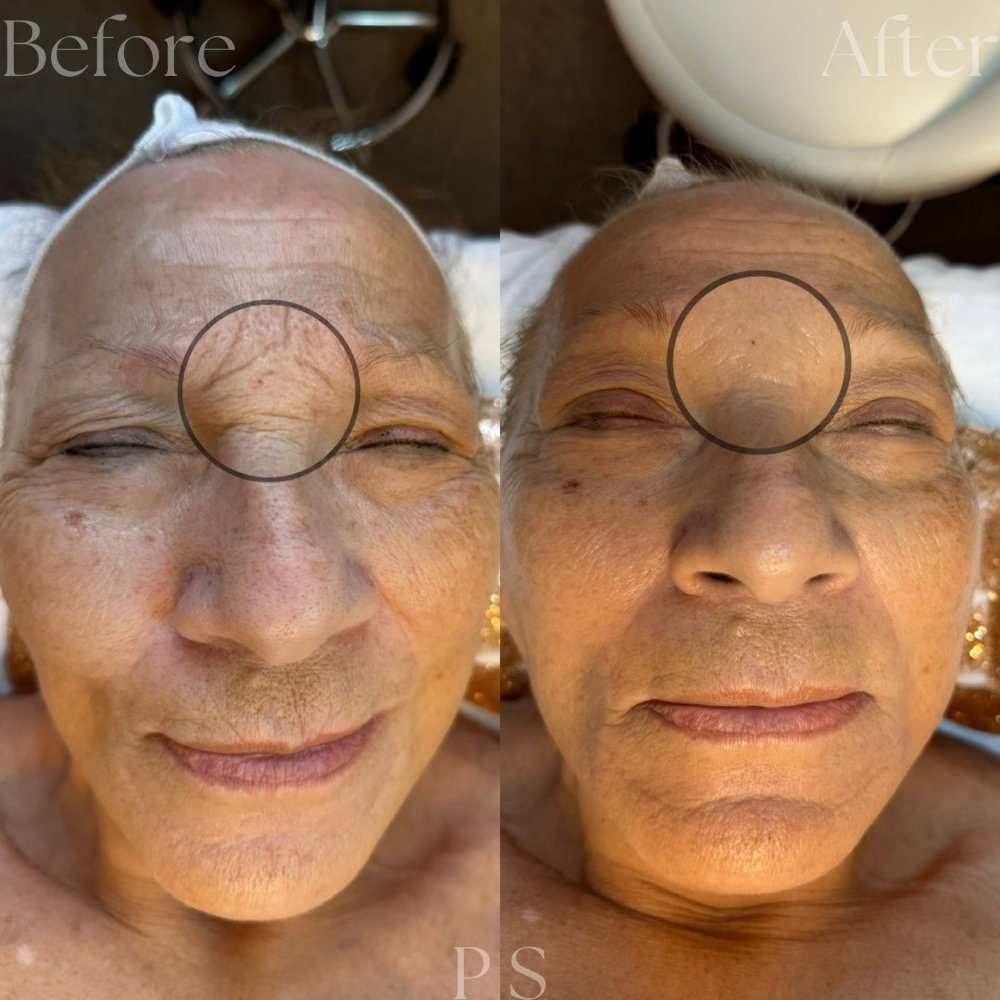 Level II Treatment - Refine