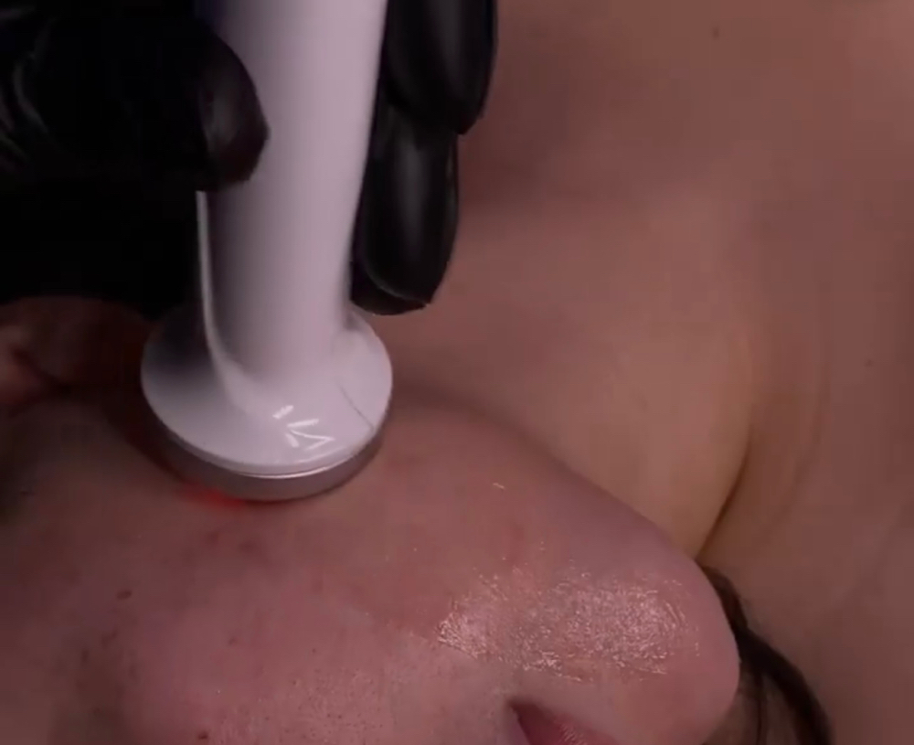 Double Chin/ Jaw Contouring